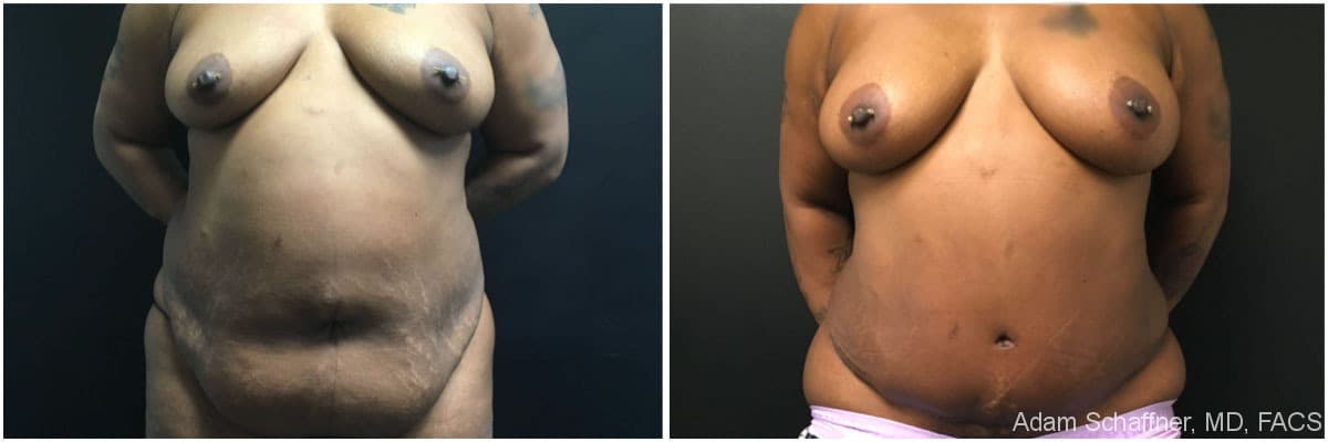 Abdominoplasty with Fat Transfer to Breasts before and after result — Adam Schaffner, MD, FACS, New York City (case 5)