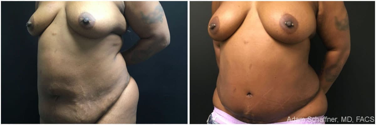 Abdominoplasty with Fat Transfer to Breasts before and after result — Adam Schaffner, MD, FACS, New York City (case 4)