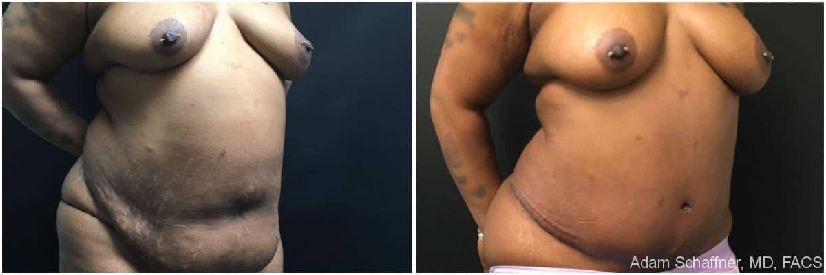 Abdominoplasty with Fat Transfer to Breasts before and after result — Adam Schaffner, MD, FACS, New York City (case 3)