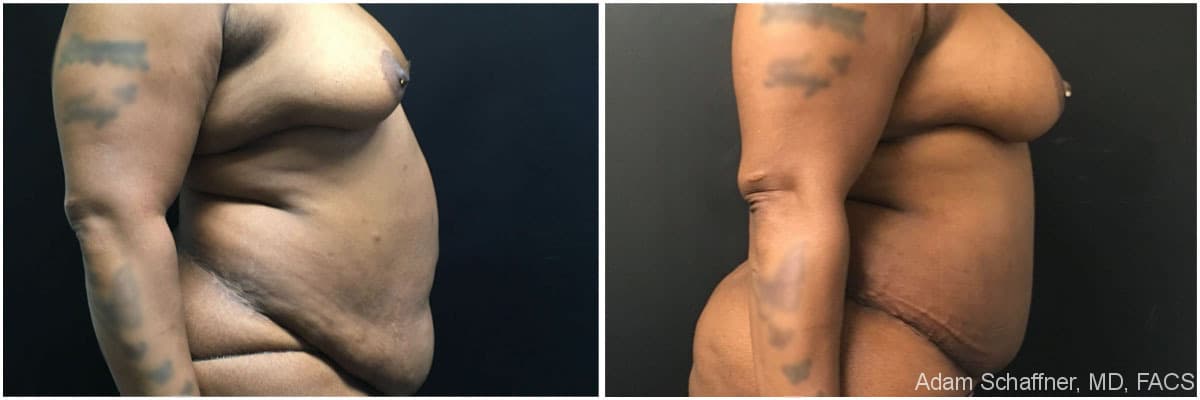Abdominoplasty with Fat Transfer to Breasts before and after result — Adam Schaffner, MD, FACS, New York City (case 2)