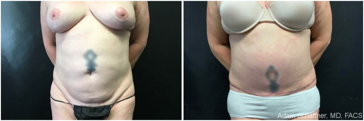 Abdominoplasty before and after result — Adam Schaffner, MD, FACS, New York City (case 10)
