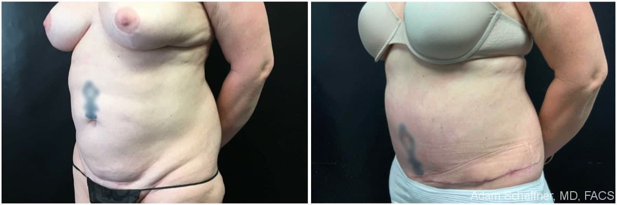 Abdominoplasty before and after result — Adam Schaffner, MD, FACS, New York City (case 9)
