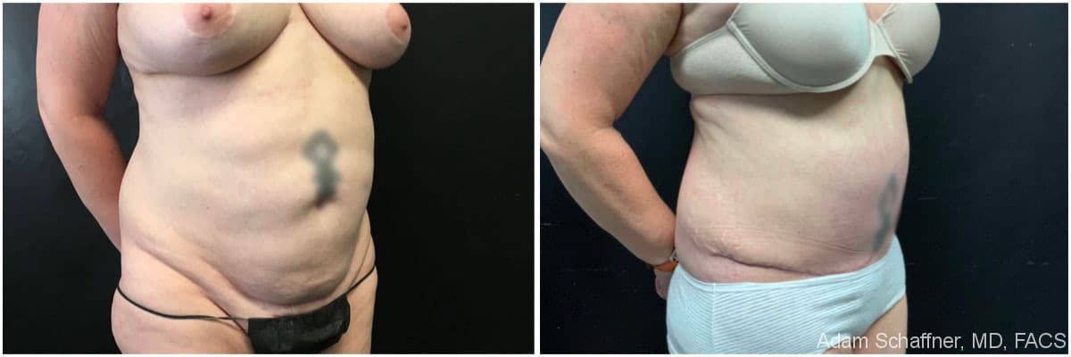 Abdominoplasty before and after result — Adam Schaffner, MD, FACS, New York City (case 8)