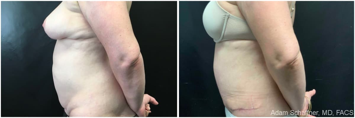 Abdominoplasty before and after result — Adam Schaffner, MD, FACS, New York City (case 7)
