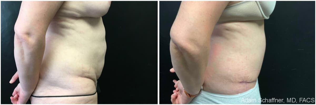 Abdominoplasty before and after result — Adam Schaffner, MD, FACS, New York City (case 6)