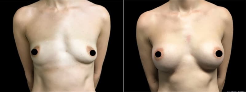 Breast Augmentation before and after result — Adam Schaffner, MD, FACS, New York City (case 18)