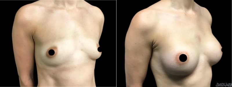 Breast Augmentation before and after result — Adam Schaffner, MD, FACS, New York City (case 17)