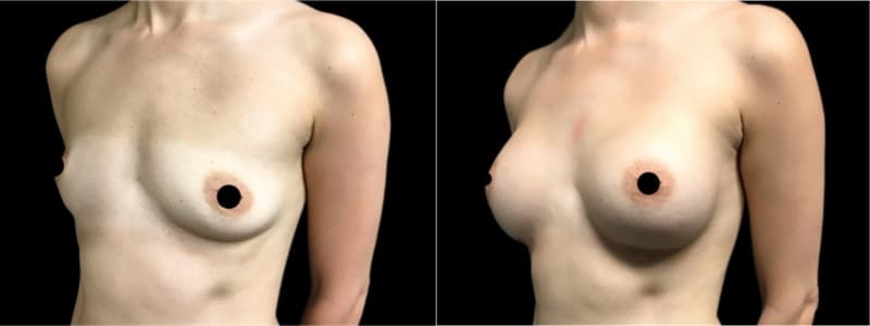 Breast Augmentation before and after result — Adam Schaffner, MD, FACS, New York City (case 16)