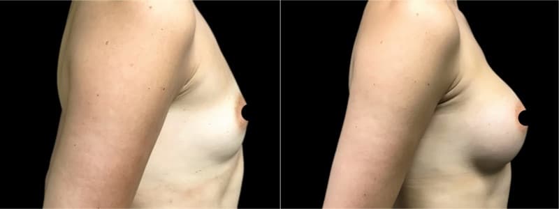 Breast Augmentation before and after result — Adam Schaffner, MD, FACS, New York City (case 19)
