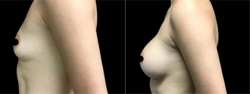 Breast Augmentation before and after result — Adam Schaffner, MD, FACS, New York City (case 20)