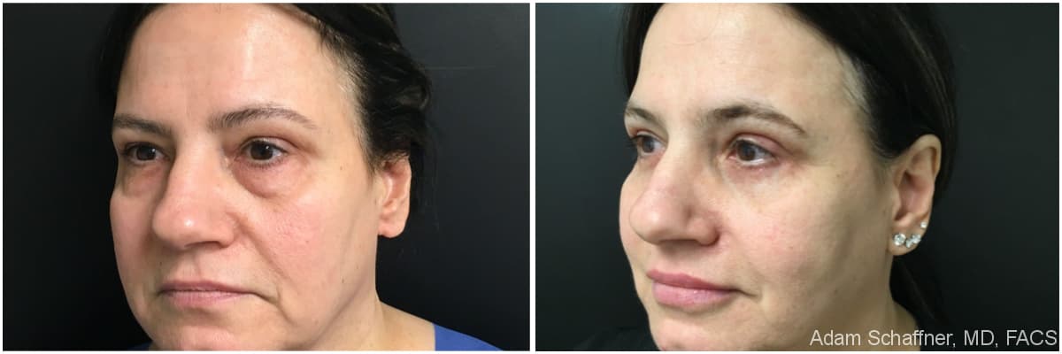 Blepharoplasty before and after result — Adam Schaffner, MD, FACS, New York City (case 20)