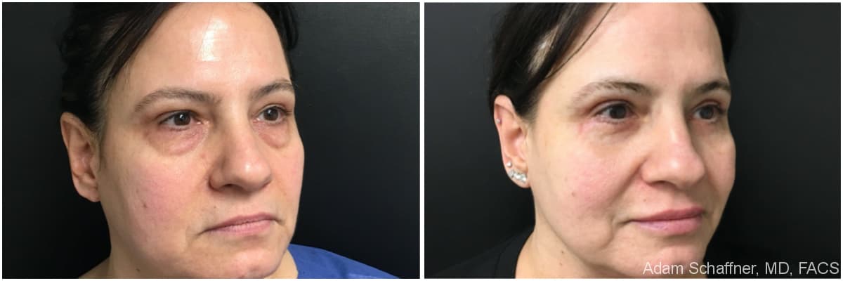 Blepharoplasty before and after result — Adam Schaffner, MD, FACS, New York City (case 19)