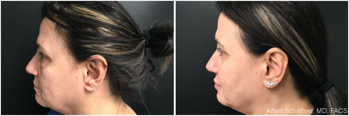 Blepharoplasty before and after result — Adam Schaffner, MD, FACS, New York City (case 18)