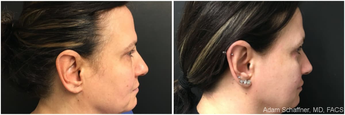 Blepharoplasty before and after result — Adam Schaffner, MD, FACS, New York City (case 17)