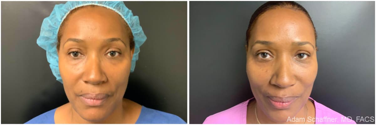 Blepharoplasty before and after result — Adam Schaffner, MD, FACS, New York City (case 16)