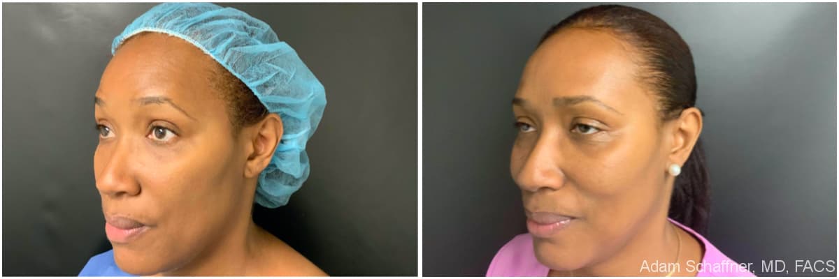 Blepharoplasty before and after result — Adam Schaffner, MD, FACS, New York City (case 15)