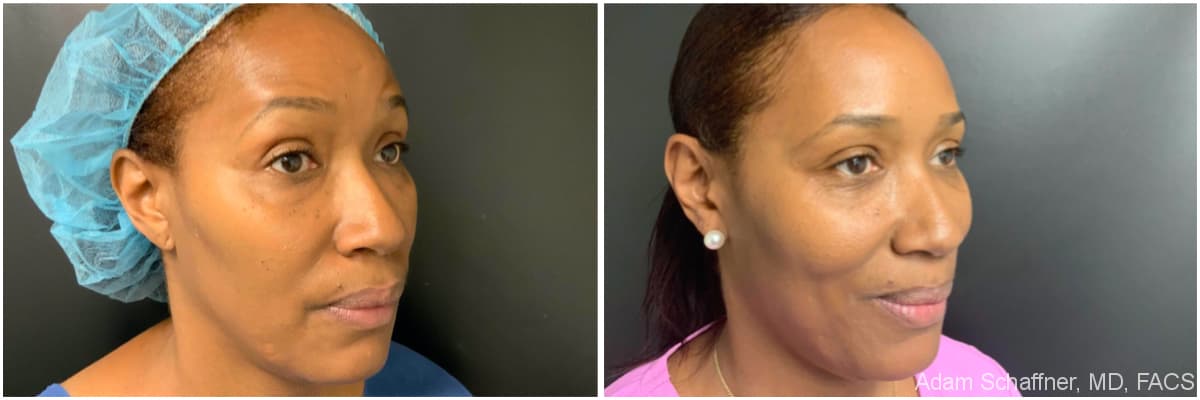 Blepharoplasty before and after result — Adam Schaffner, MD, FACS, New York City (case 14)