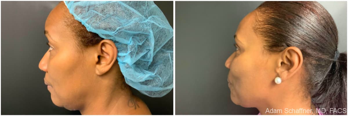 Blepharoplasty before and after result — Adam Schaffner, MD, FACS, New York City (case 13)