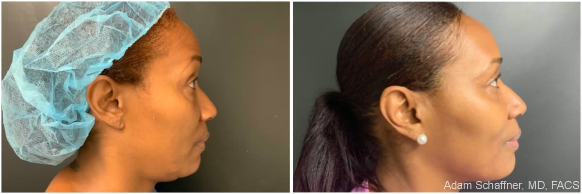 Blepharoplasty before and after result — Adam Schaffner, MD, FACS, New York City (case 12)