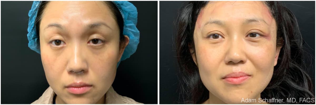 Blepharoplasty before and after result — Adam Schaffner, MD, FACS, New York City (case 11)