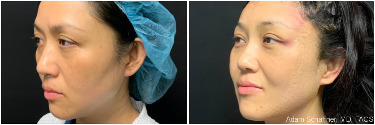 Blepharoplasty before and after result — Adam Schaffner, MD, FACS, New York City (case 10)
