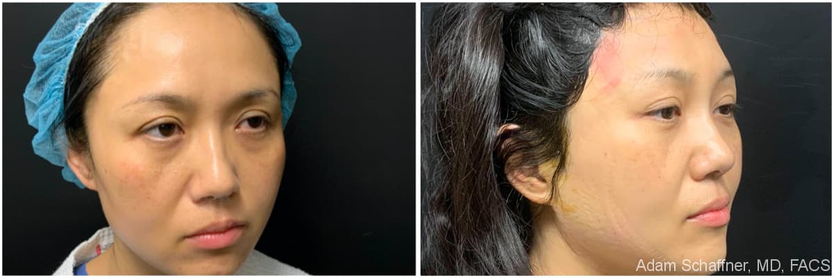 Blepharoplasty before and after result — Adam Schaffner, MD, FACS, New York City (case 9)