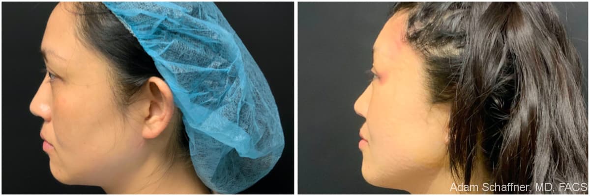 Blepharoplasty before and after result — Adam Schaffner, MD, FACS, New York City (case 8)