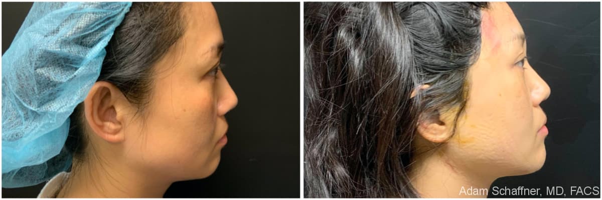 Blepharoplasty before and after result — Adam Schaffner, MD, FACS, New York City (case 7)