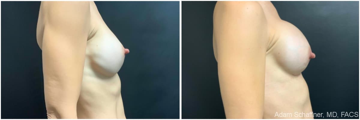 Breast Augmentation with Mastopexy before and after result — Adam Schaffner, MD, FACS, New York City (case 20)
