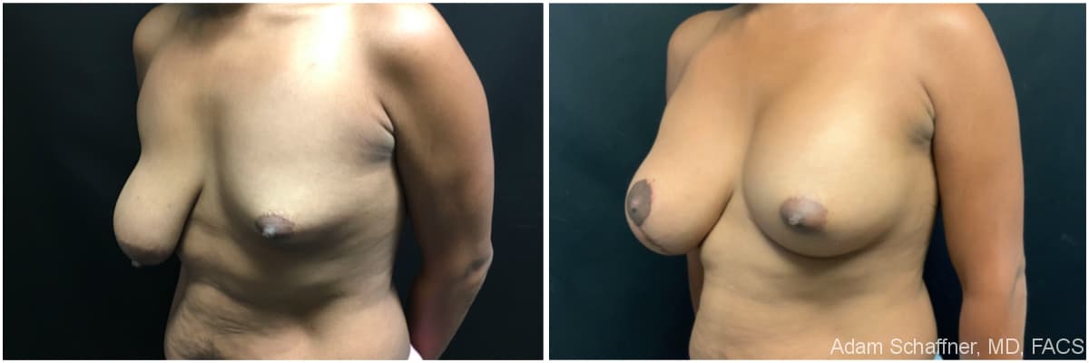 Breast Augmentation with Mastopexy before and after result — Adam Schaffner, MD, FACS, New York City (case 18)