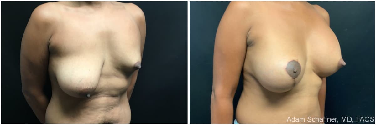 Breast Augmentation with Mastopexy before and after result — Adam Schaffner, MD, FACS, New York City (case 17)