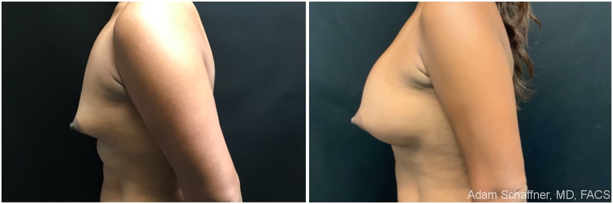 Breast Augmentation with Mastopexy before and after result — Adam Schaffner, MD, FACS, New York City (case 16)