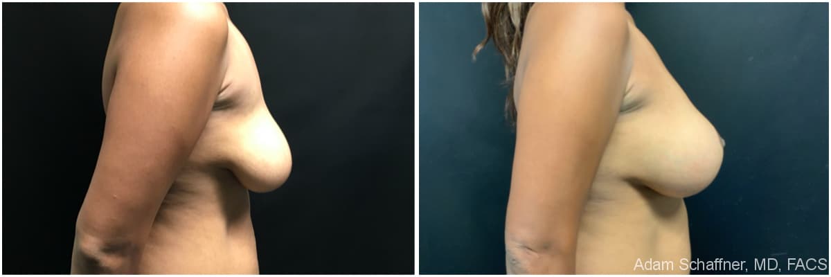 Breast Augmentation with Mastopexy before and after result — Adam Schaffner, MD, FACS, New York City (case 15)