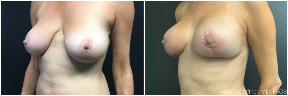 Breast Augmentation with Mastopexy before and after result — Adam Schaffner, MD, FACS, New York City (case 13)