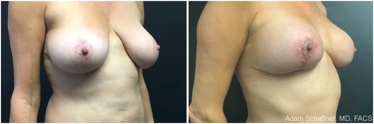 Breast Augmentation with Mastopexy before and after result — Adam Schaffner, MD, FACS, New York City (case 12)