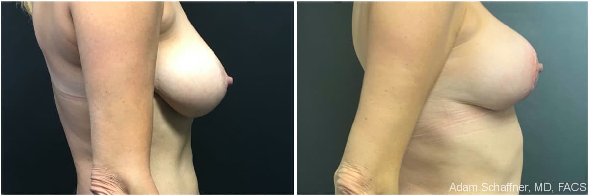Breast Augmentation with Mastopexy before and after result — Adam Schaffner, MD, FACS, New York City (case 10)