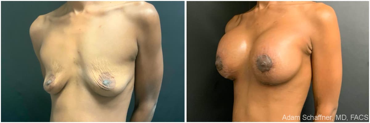 Breast Augmentation with Mastopexy before and after result — Adam Schaffner, MD, FACS, New York City (case 8)
