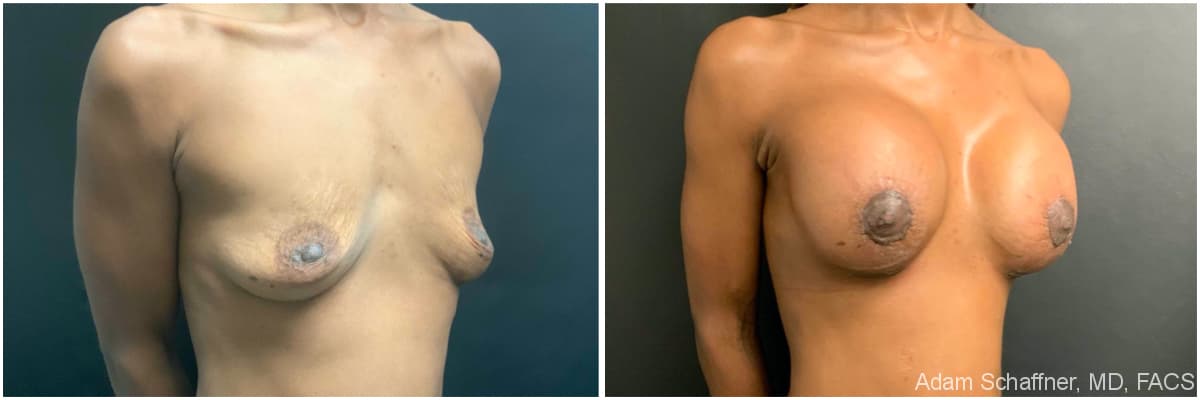 Breast Augmentation with Mastopexy before and after result — Adam Schaffner, MD, FACS, New York City (case 7)
