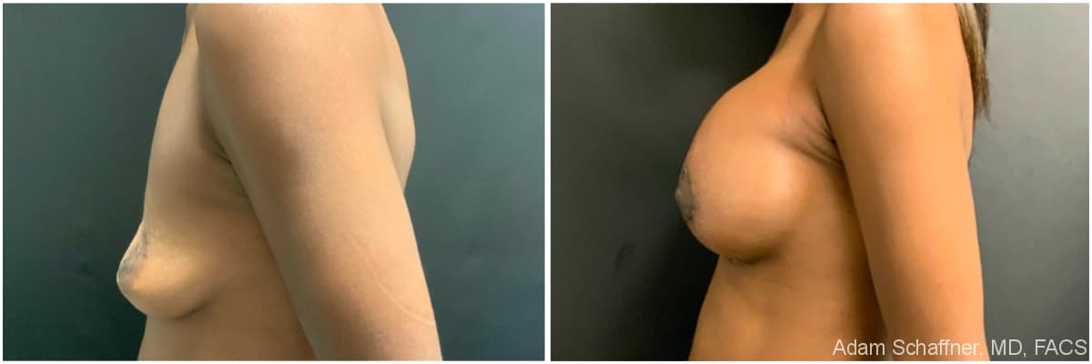 Breast Augmentation with Mastopexy before and after result — Adam Schaffner, MD, FACS, New York City (case 6)
