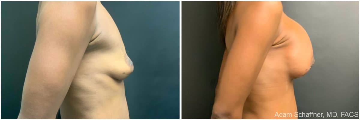 Breast Augmentation with Mastopexy before and after result — Adam Schaffner, MD, FACS, New York City (case 5)