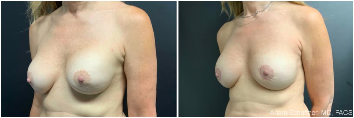 Breast Augmentation with Mastopexy before and after result — Adam Schaffner, MD, FACS, New York City (case 3)