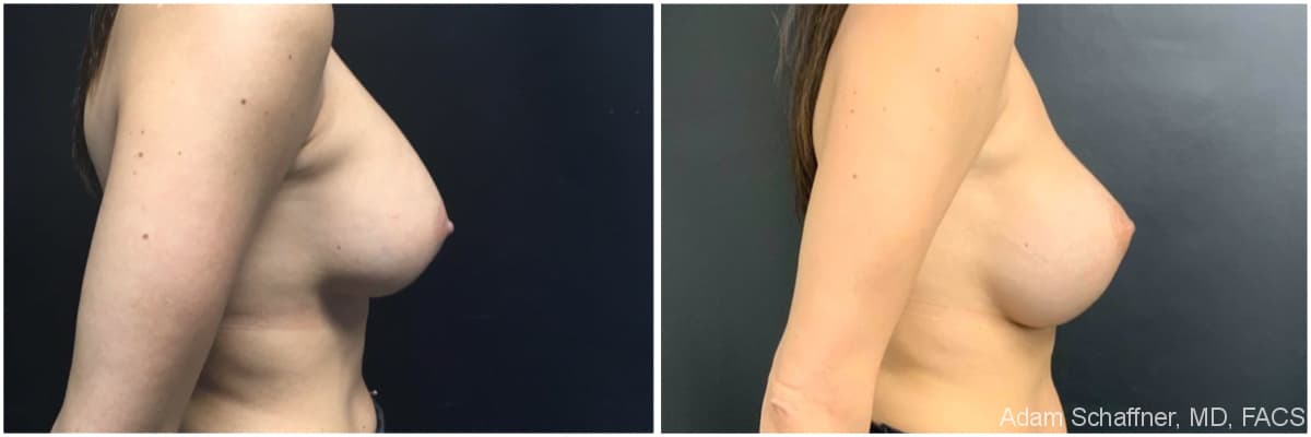 Breast Implants Exchange before and after result — Adam Schaffner, MD, FACS, New York City (case 18)