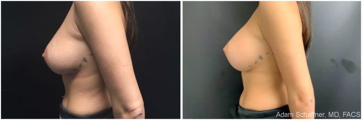 Breast Implants Exchange before and after result — Adam Schaffner, MD, FACS, New York City (case 17)