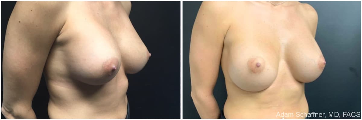 Breast Implants Exchange before and after result — Adam Schaffner, MD, FACS, New York City (case 16)