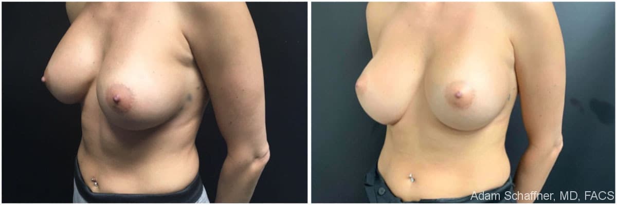 Breast Implants Exchange before and after result — Adam Schaffner, MD, FACS, New York City (case 15)