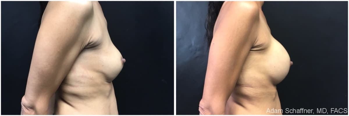 Breast Implants Exchange before and after result — Adam Schaffner, MD, FACS, New York City (case 13)
