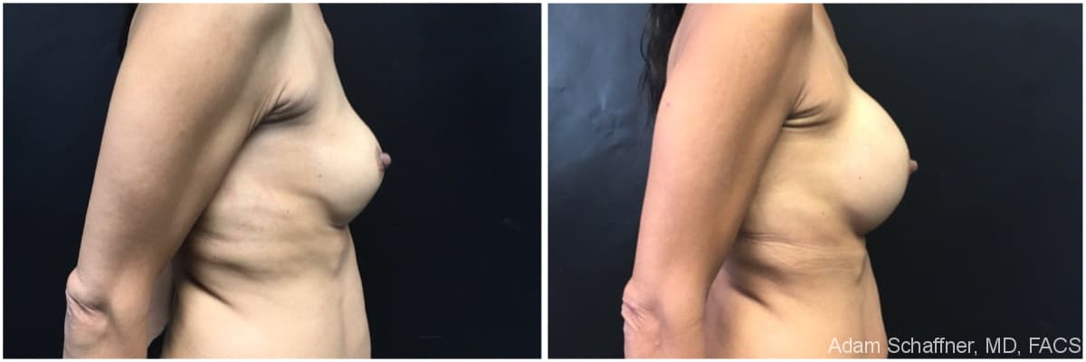 Breast Implants Exchange before and after result — Adam Schaffner, MD, FACS, New York City (case 12)
