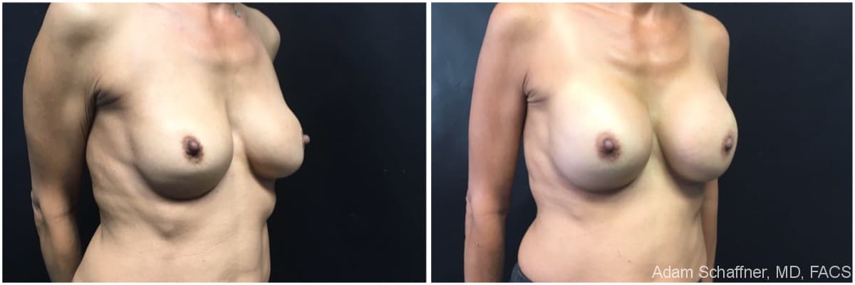 Breast Implants Exchange before and after result — Adam Schaffner, MD, FACS, New York City (case 11)