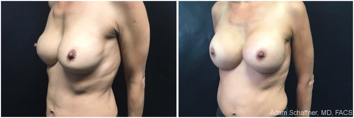 Breast Implants Exchange before and after result — Adam Schaffner, MD, FACS, New York City (case 10)