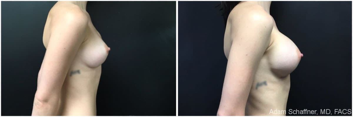 Breast Implants Exchange before and after result — Adam Schaffner, MD, FACS, New York City (case 8)